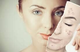 Înlocuirea Botox