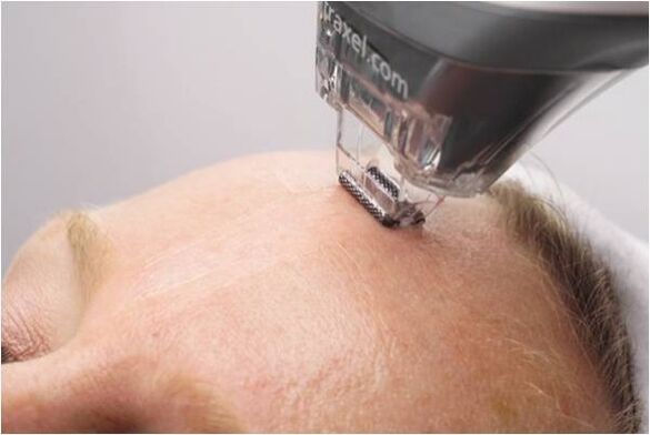 procedura de peeling pentru intinerirea pielii fetei